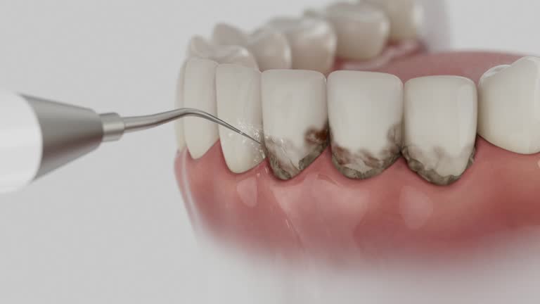 Trusted Wisdom Tooth Removal service in Stony Brook, NY - Dentist Open Now